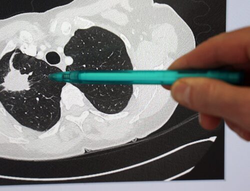 Un vaccin thérapeutique français, le Tedopi, serait en mesure de diminuer le risque de décès chez les patients atteints d’un cancer avancé du poumon.